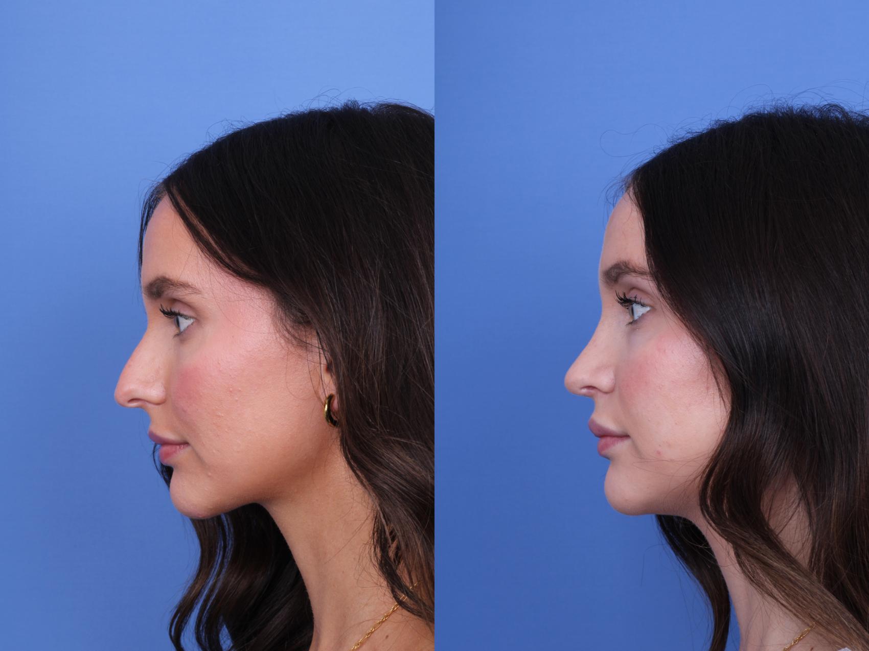 Before & After Rhinoplasty Case 724 Left Side View in Scottsdale, AZ
