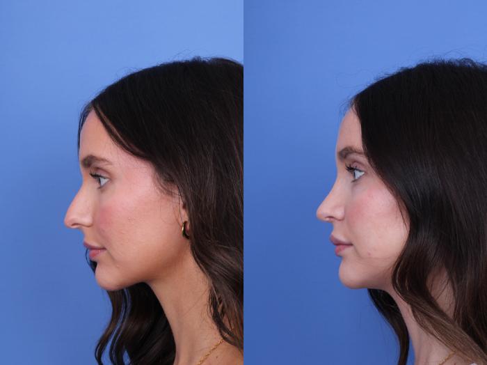 Before & After Rhinoplasty Case 724 Left Side View in Scottsdale, AZ