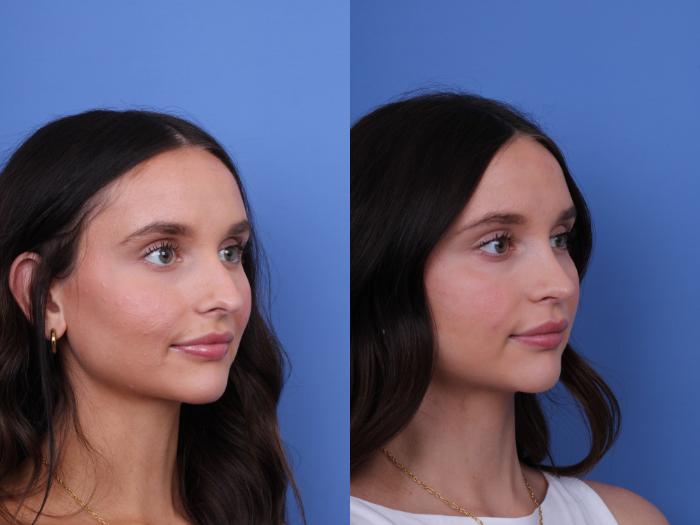 Before & After Rhinoplasty Case 724 Right Oblique View in Scottsdale, AZ