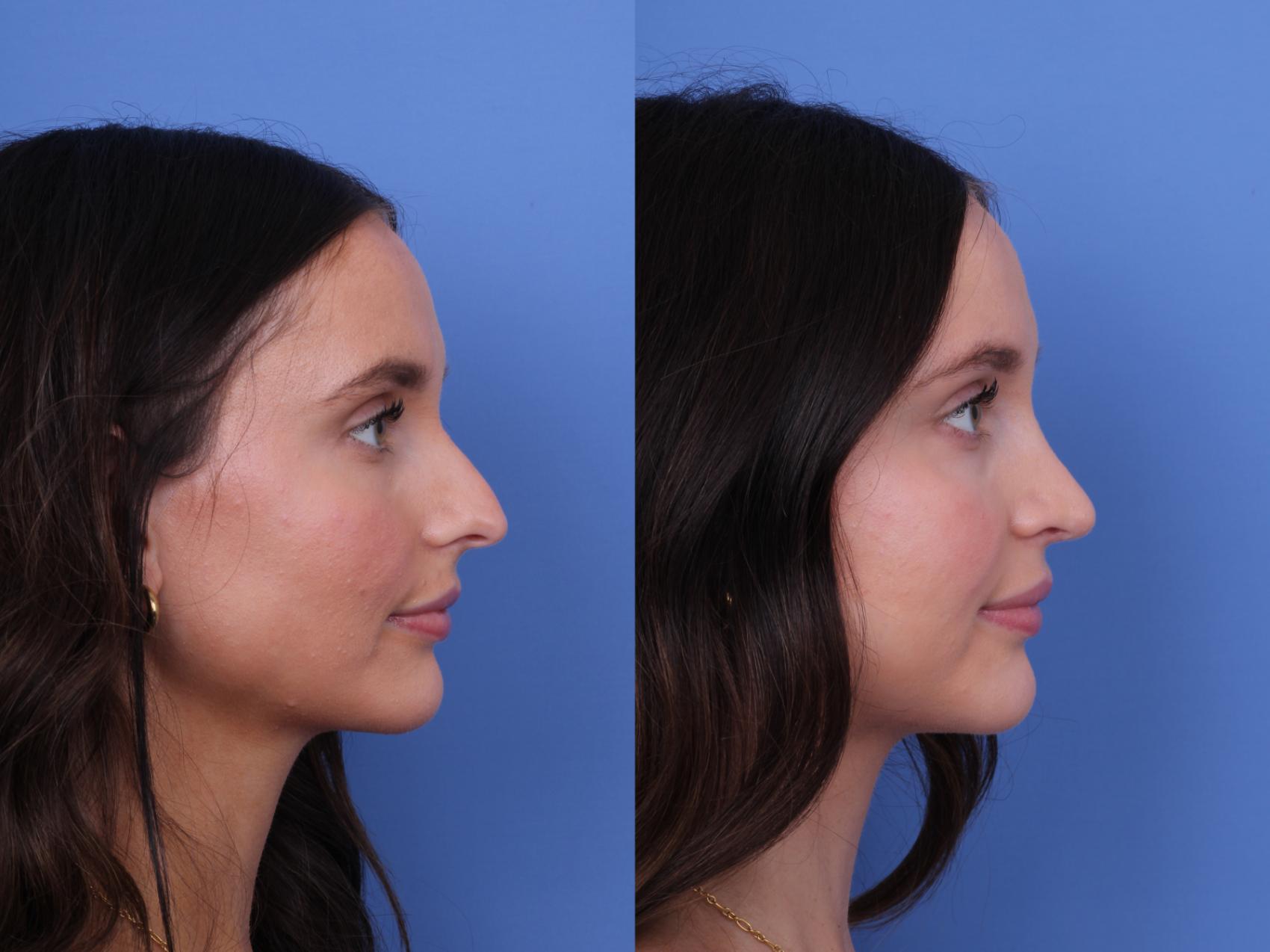 Before & After Rhinoplasty Case 724 Right Side View in Scottsdale, AZ