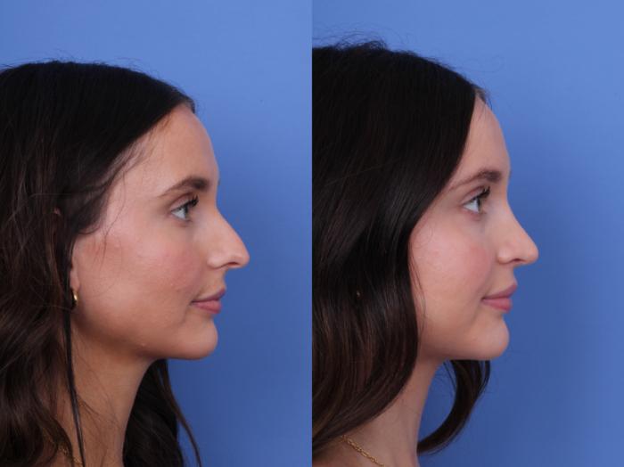 Before & After Rhinoplasty Case 724 Right Side View in Scottsdale, AZ