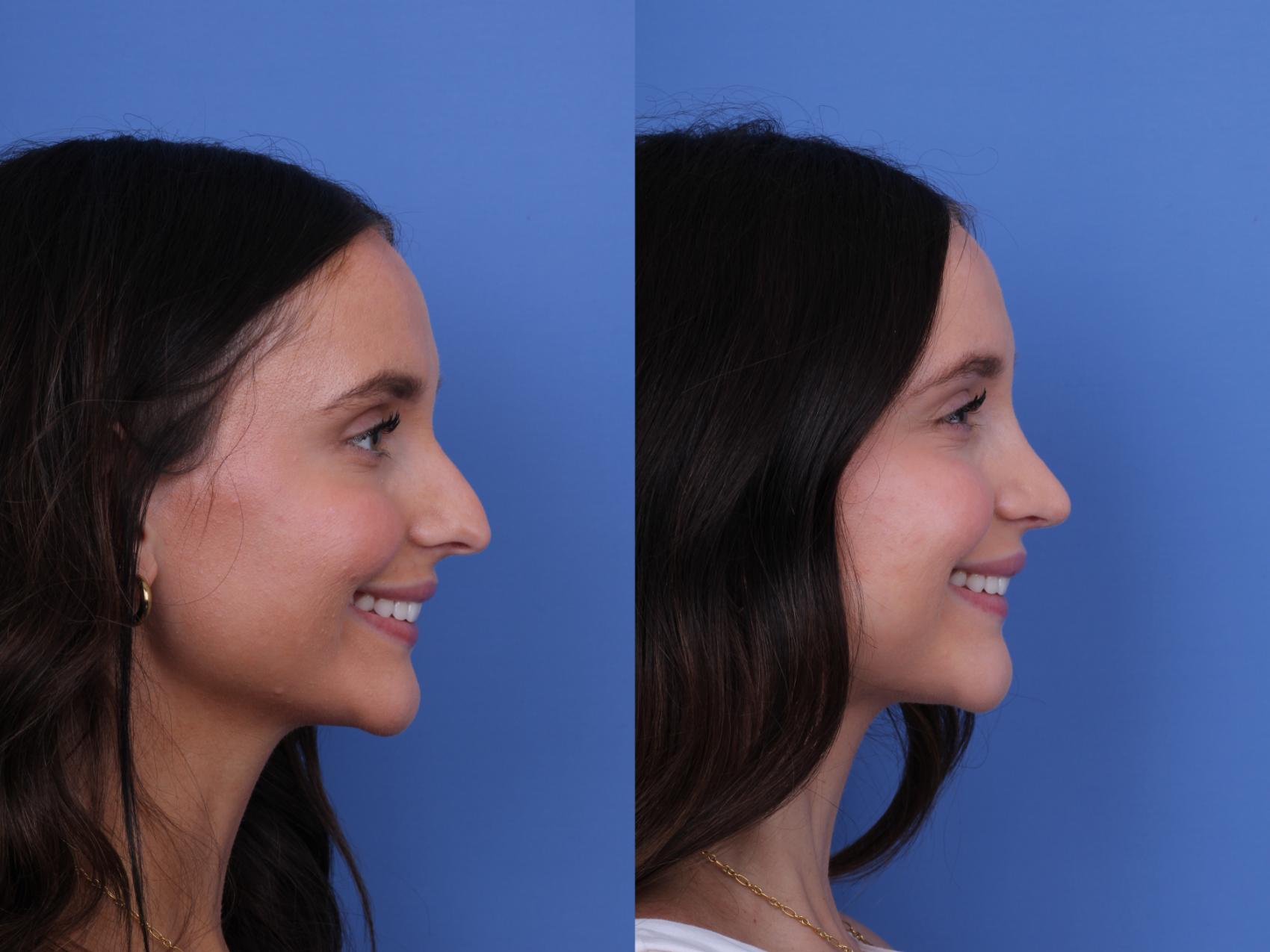 Before & After Rhinoplasty Case 724 Right Smile View in Scottsdale, AZ