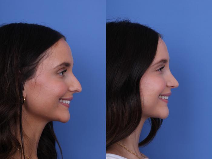 Before & After Rhinoplasty Case 724 Right Smile View in Scottsdale, AZ