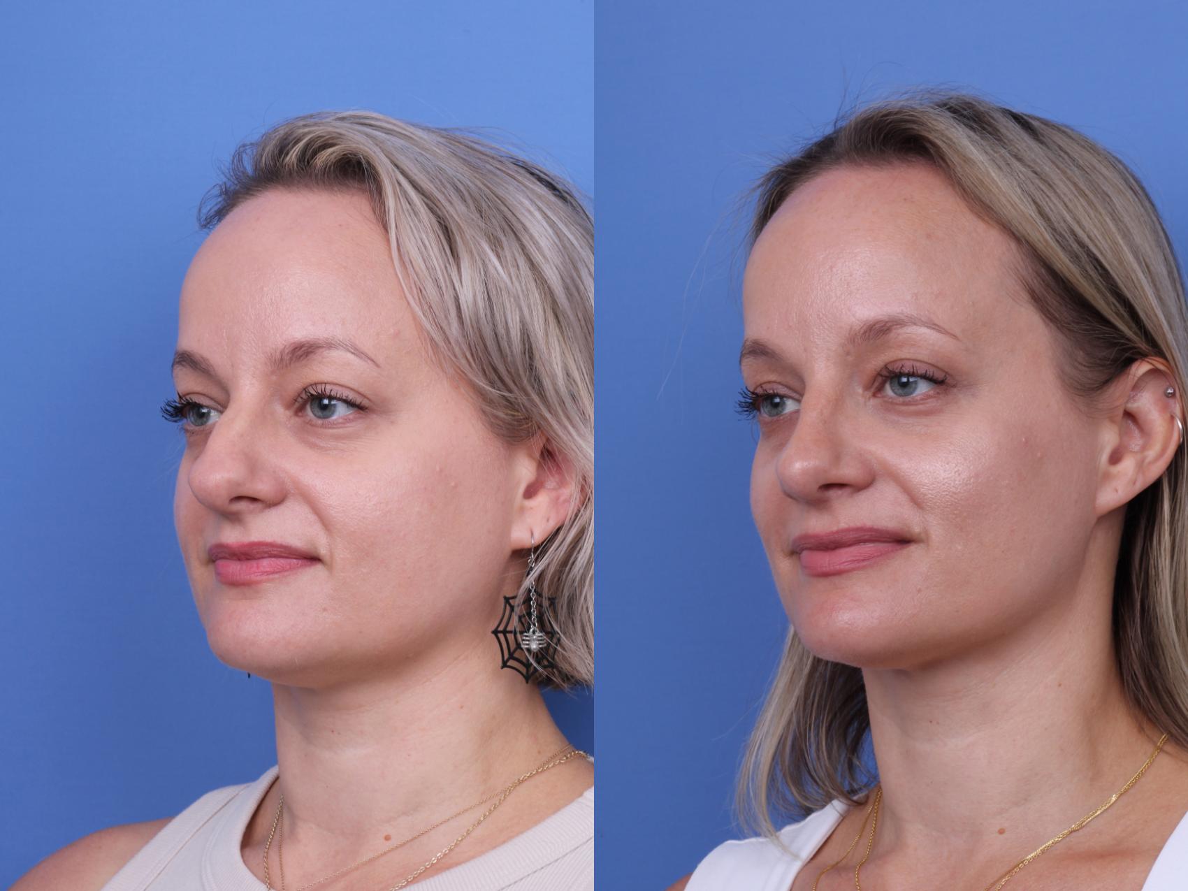 Before & After Rhinoplasty Case 730 Left Oblique View in Scottsdale, AZ