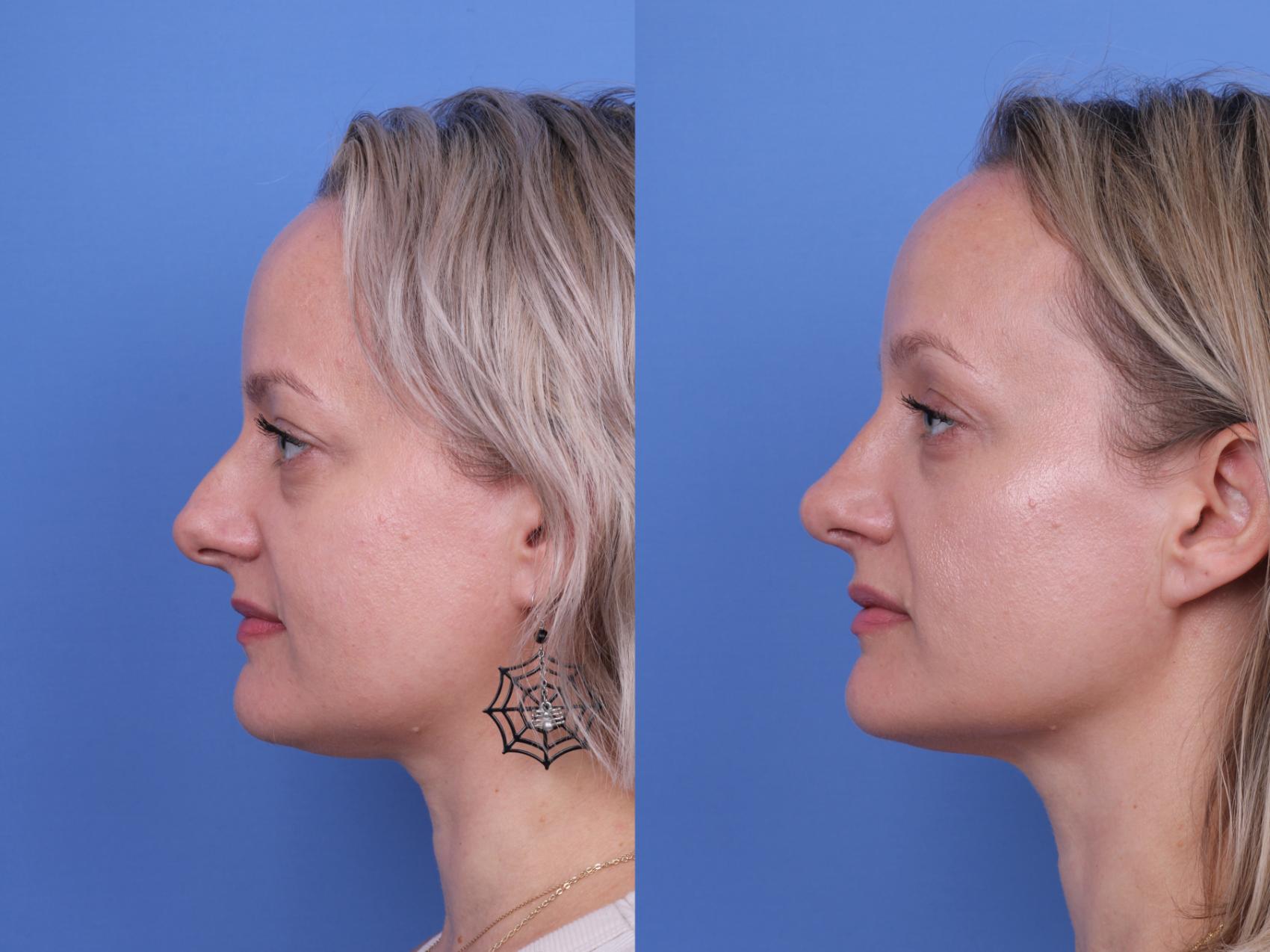 Before & After Rhinoplasty Case 730 Left Side View in Scottsdale, AZ