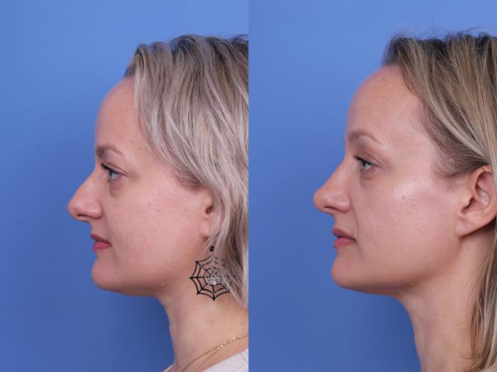 Before & After Rhinoplasty Case 730 Left Side View in Scottsdale, AZ