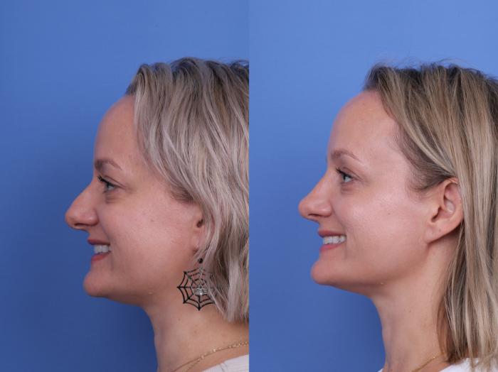 Before & After Rhinoplasty Case 730 Left Smile View in Scottsdale, AZ