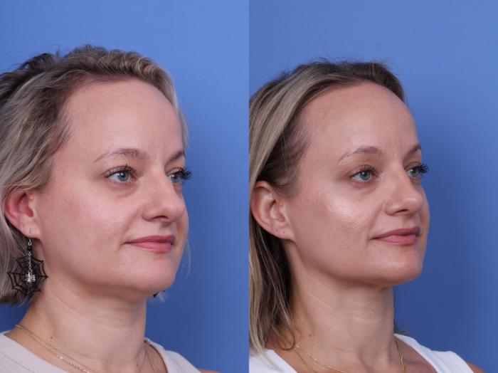 Before & After Rhinoplasty Case 730 Right Oblique View in Scottsdale, AZ