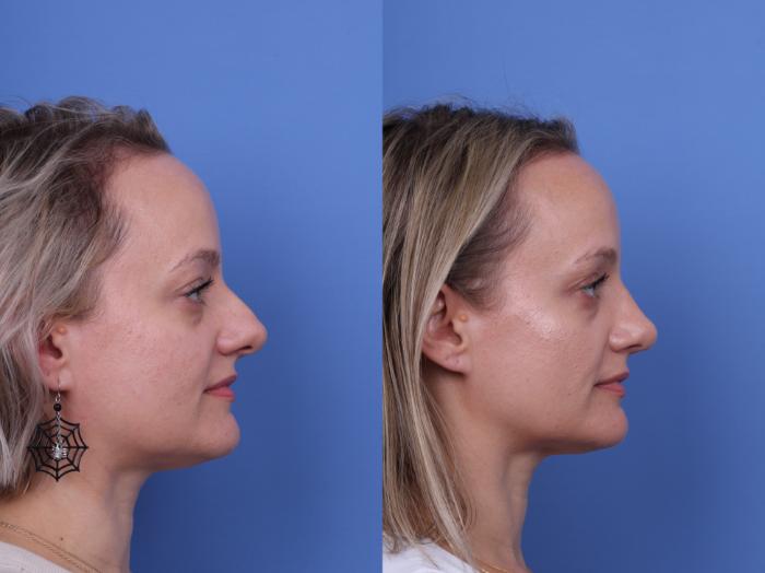 Before & After Rhinoplasty Case 730 Right Side View in Scottsdale, AZ