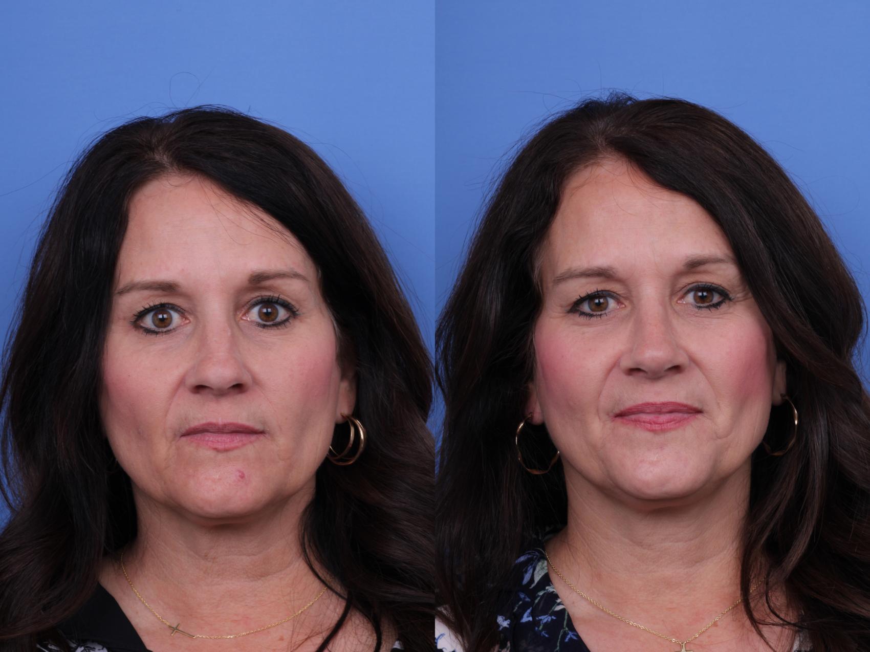 Before & After Rhinoplasty Case 731 Front View in Scottsdale, AZ