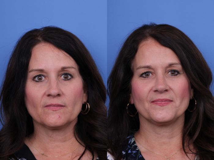 Before & After Rhinoplasty Case 731 Front View in Scottsdale, AZ