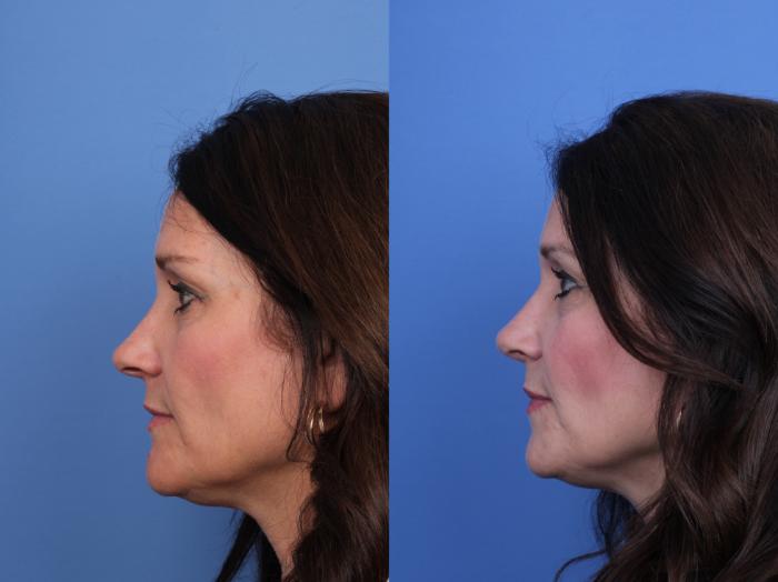 Before & After Rhinoplasty Case 731 Left Side View in Scottsdale, AZ