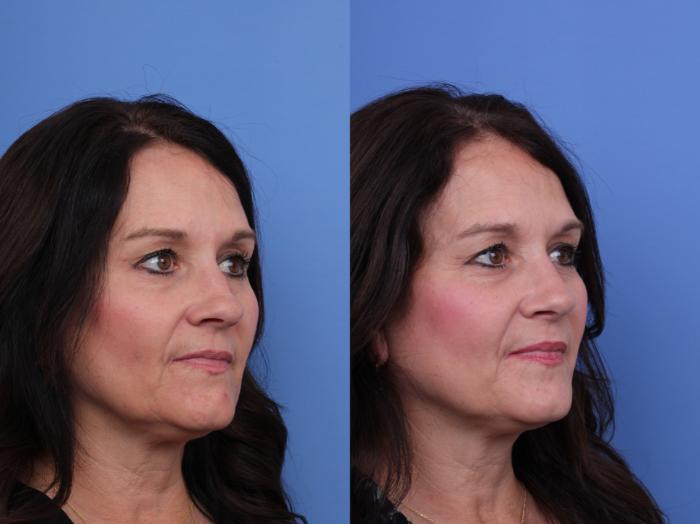Before & After Rhinoplasty Case 731 Right Oblique View in Scottsdale, AZ