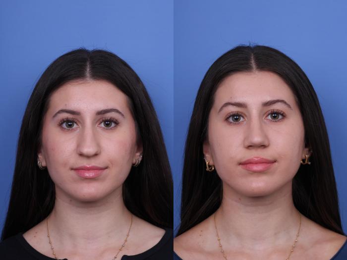 Before & After Rhinoplasty Case 733 Front View in Scottsdale, AZ
