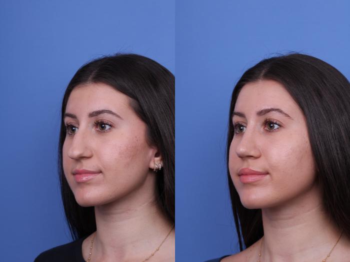 Before & After Rhinoplasty Case 733 Left Oblique View in Scottsdale, AZ