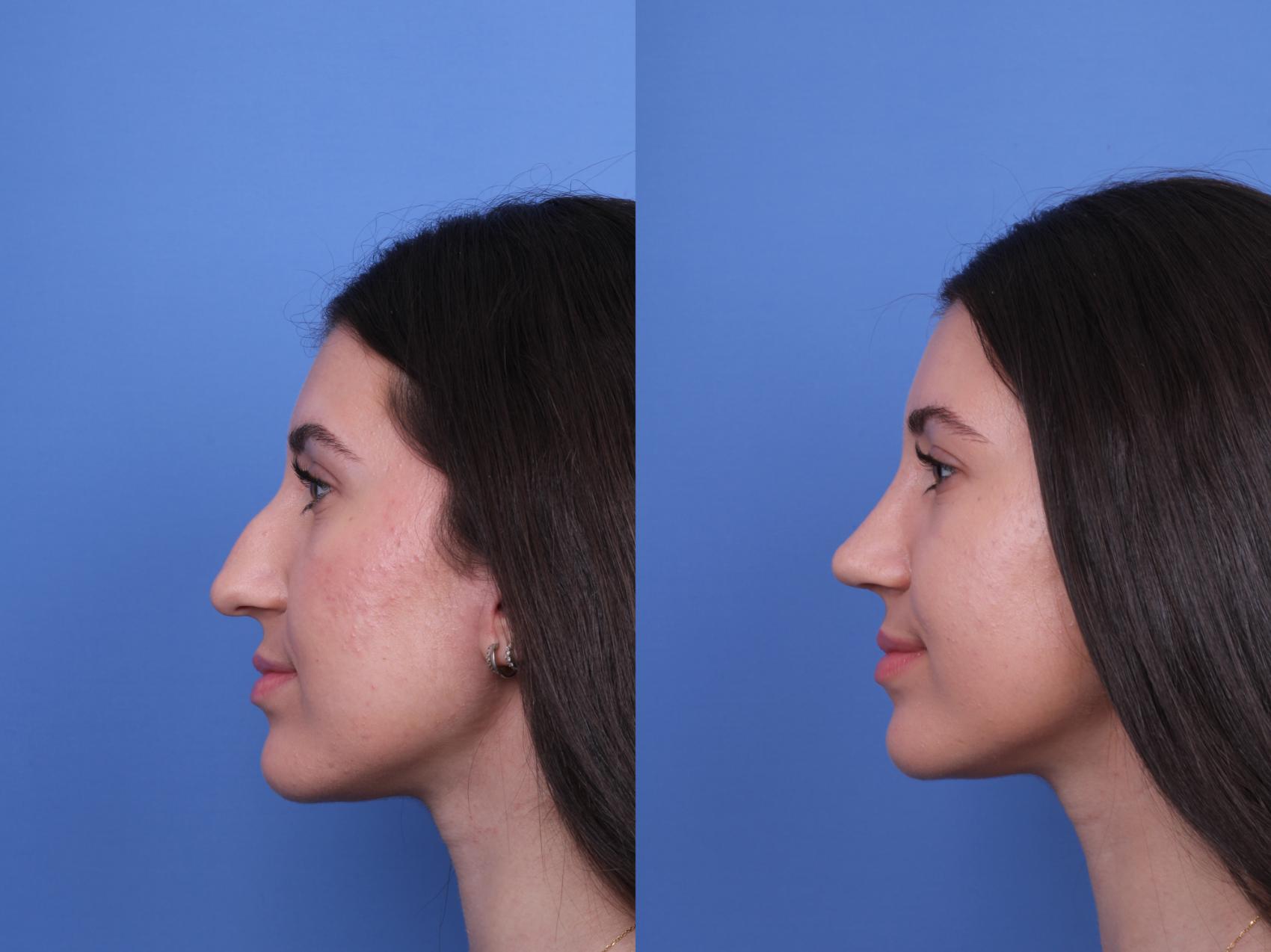 Before & After Rhinoplasty Case 733 Left Side View in Scottsdale, AZ