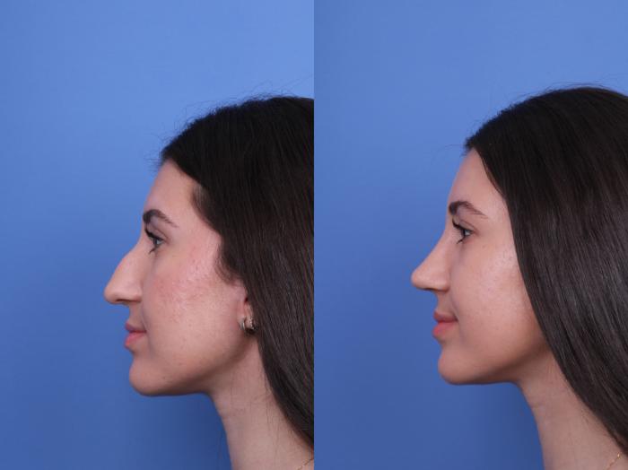 Before & After Rhinoplasty Case 733 Left Side View in Scottsdale, AZ