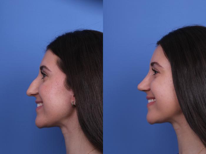 Before & After Rhinoplasty Case 733 Left Smile View in Scottsdale, AZ