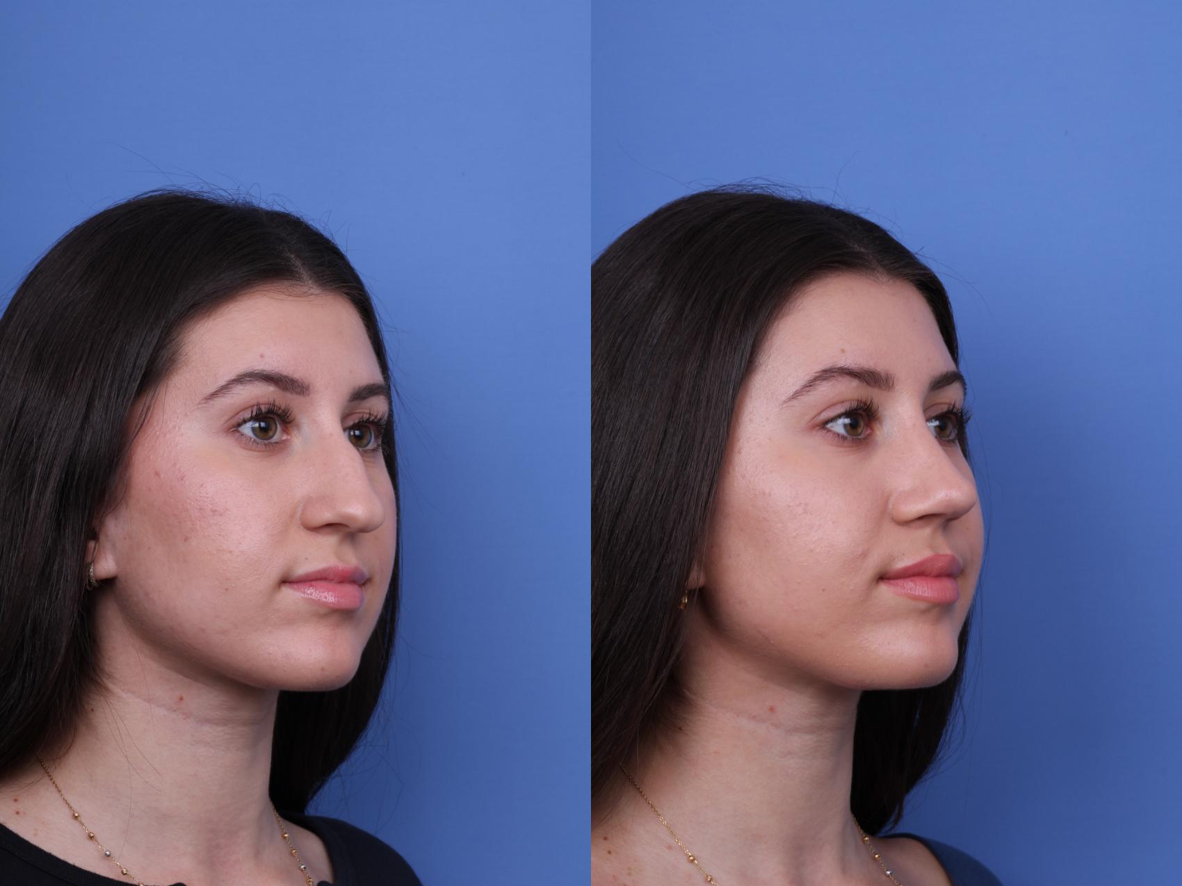 Before & After Rhinoplasty Case 733 Right Oblique View in Scottsdale, AZ
