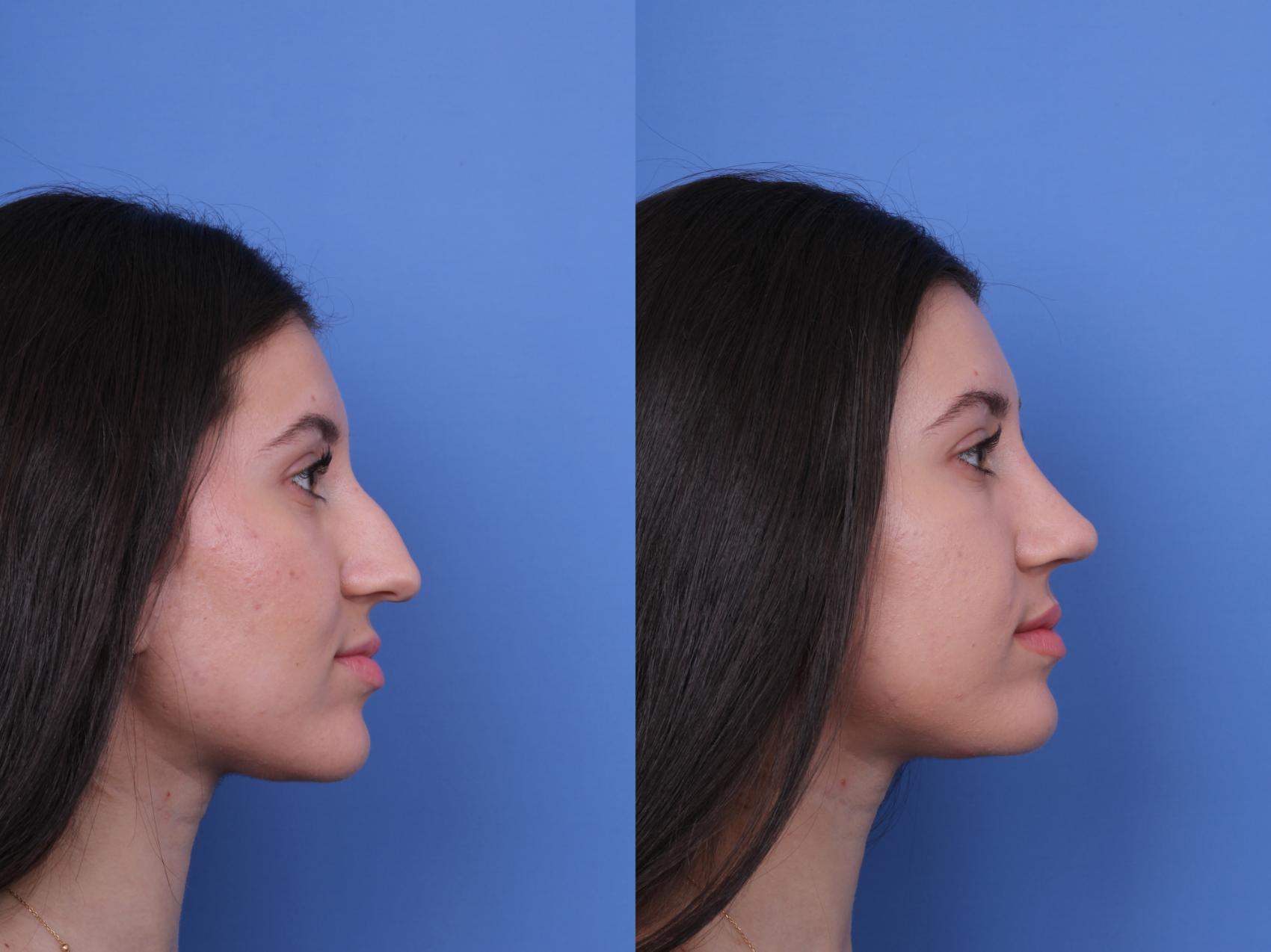 Before & After Rhinoplasty Case 733 Right Side View in Scottsdale, AZ