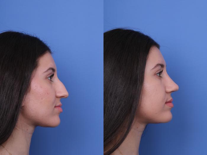 Before & After Rhinoplasty Case 733 Right Side View in Scottsdale, AZ