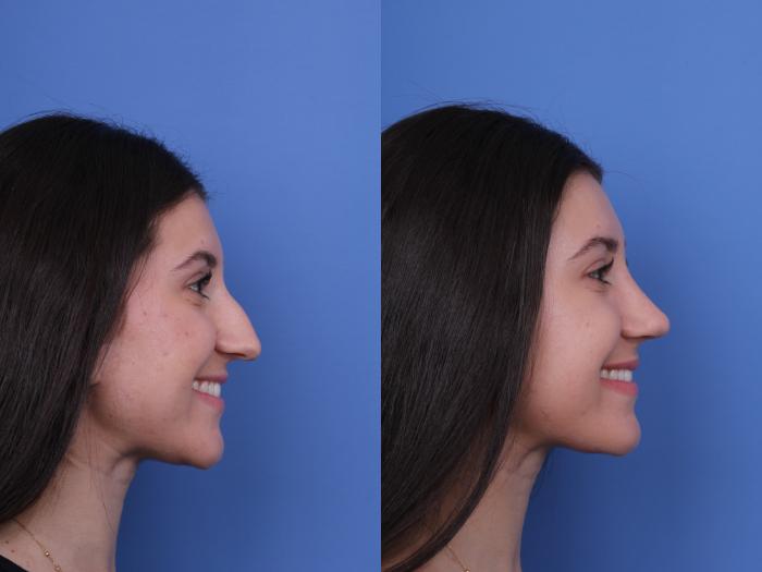 Before & After Rhinoplasty Case 733 Right Smile View in Scottsdale, AZ