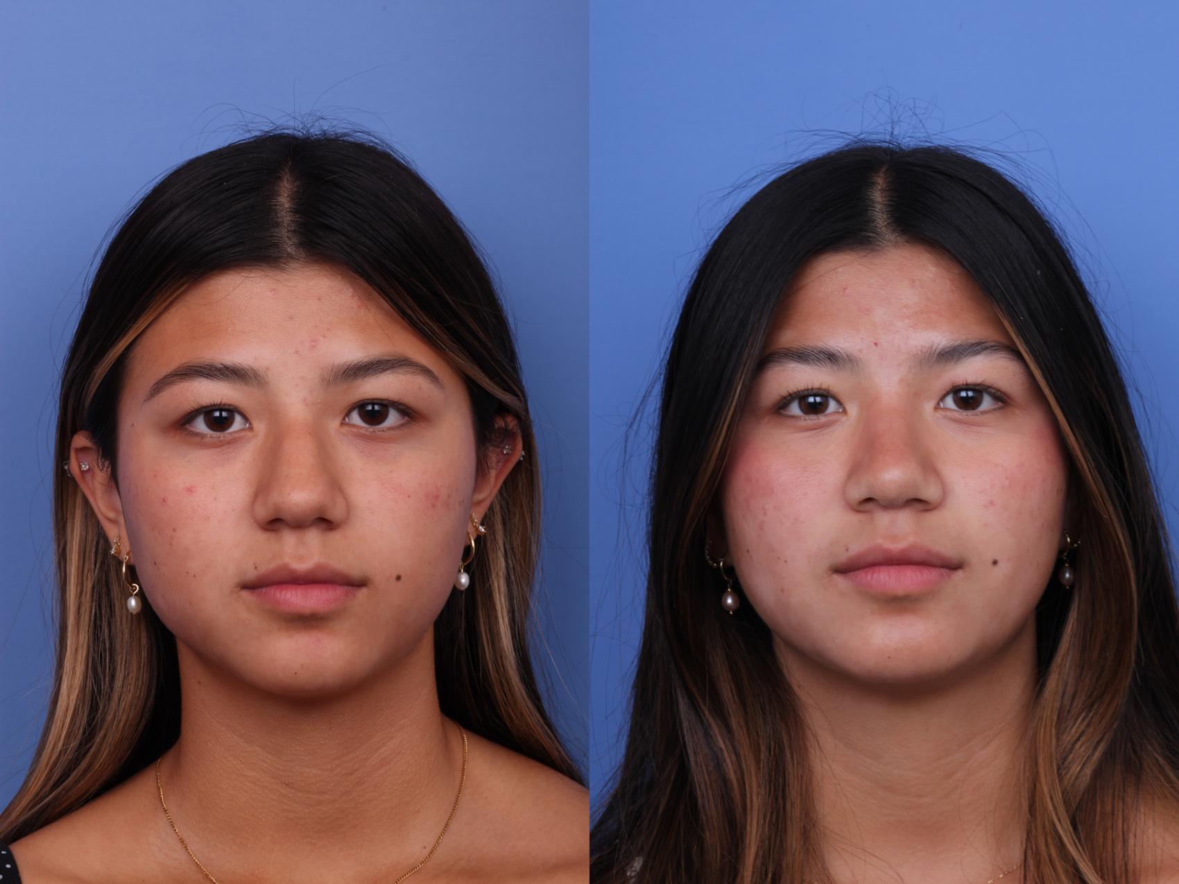 Before & After Rhinoplasty Case 734 Front View in Scottsdale, AZ
