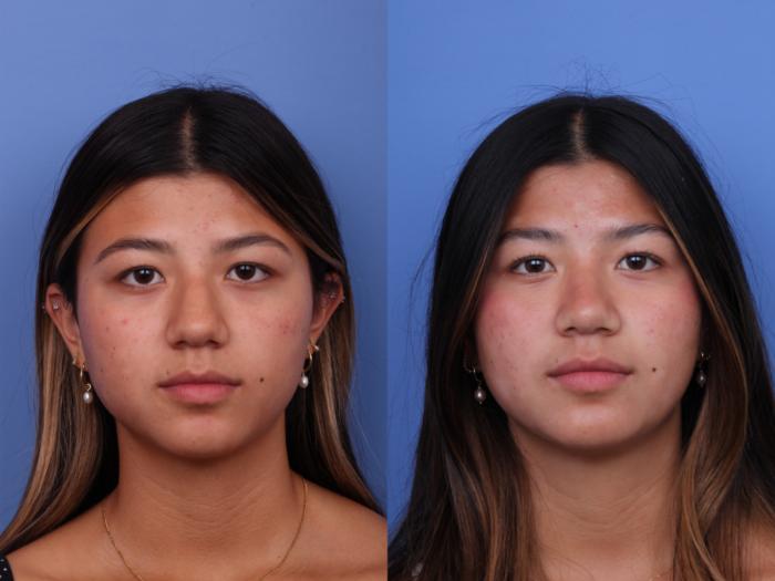 Before & After Rhinoplasty Case 734 Front View in Scottsdale, AZ