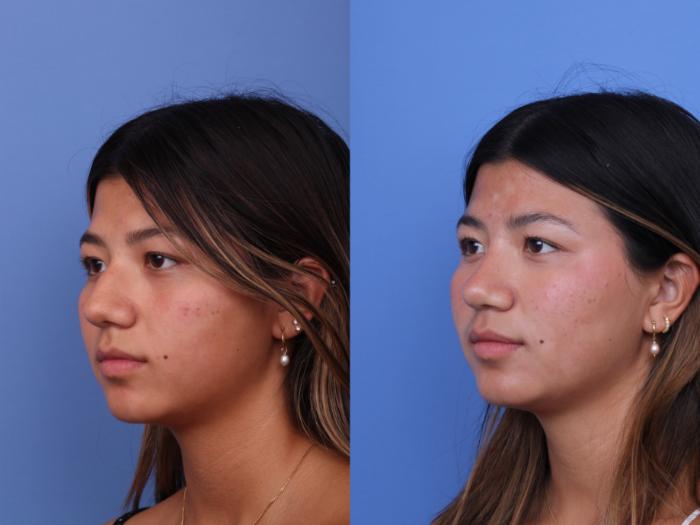 Before & After Rhinoplasty Case 734 Left Oblique View in Scottsdale, AZ