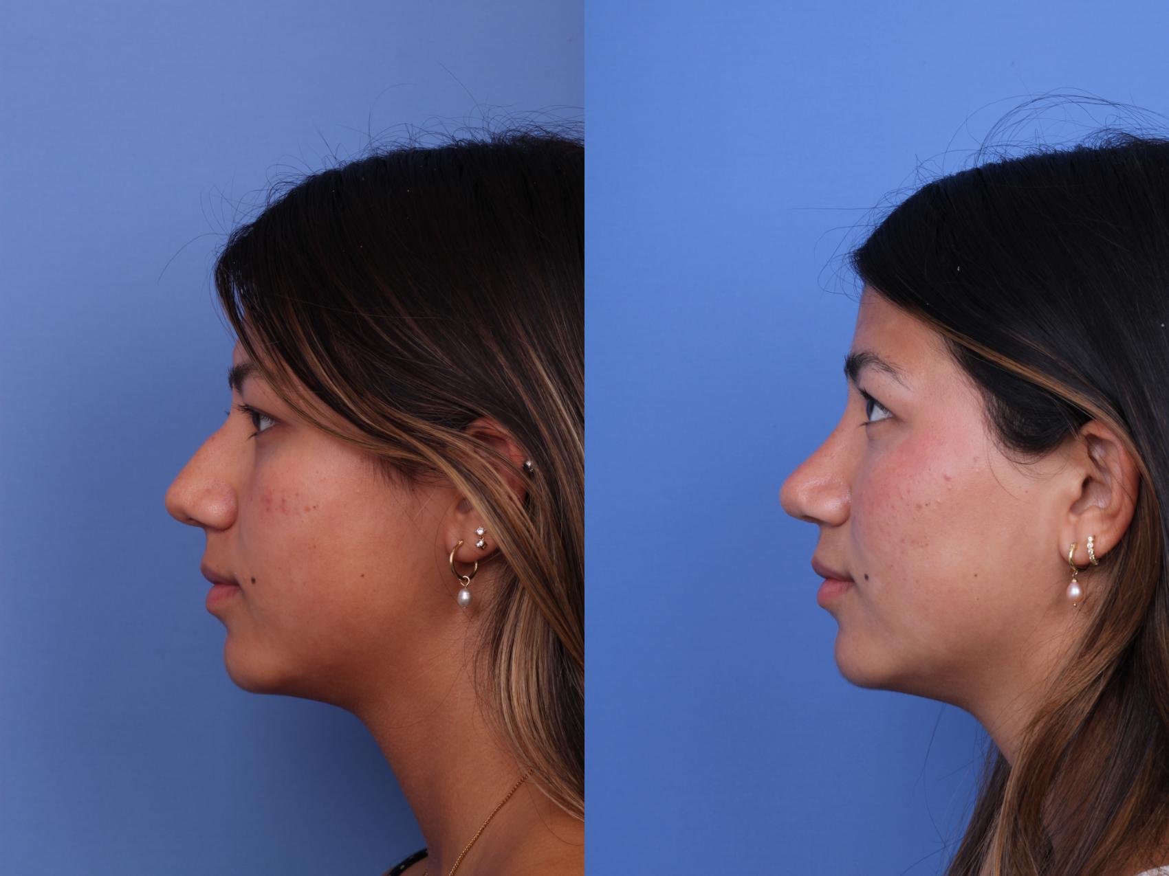 Before & After Rhinoplasty Case 734 Left Side View in Scottsdale, AZ