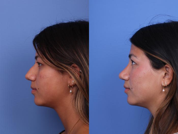 Before & After Rhinoplasty Case 734 Left Side View in Scottsdale, AZ