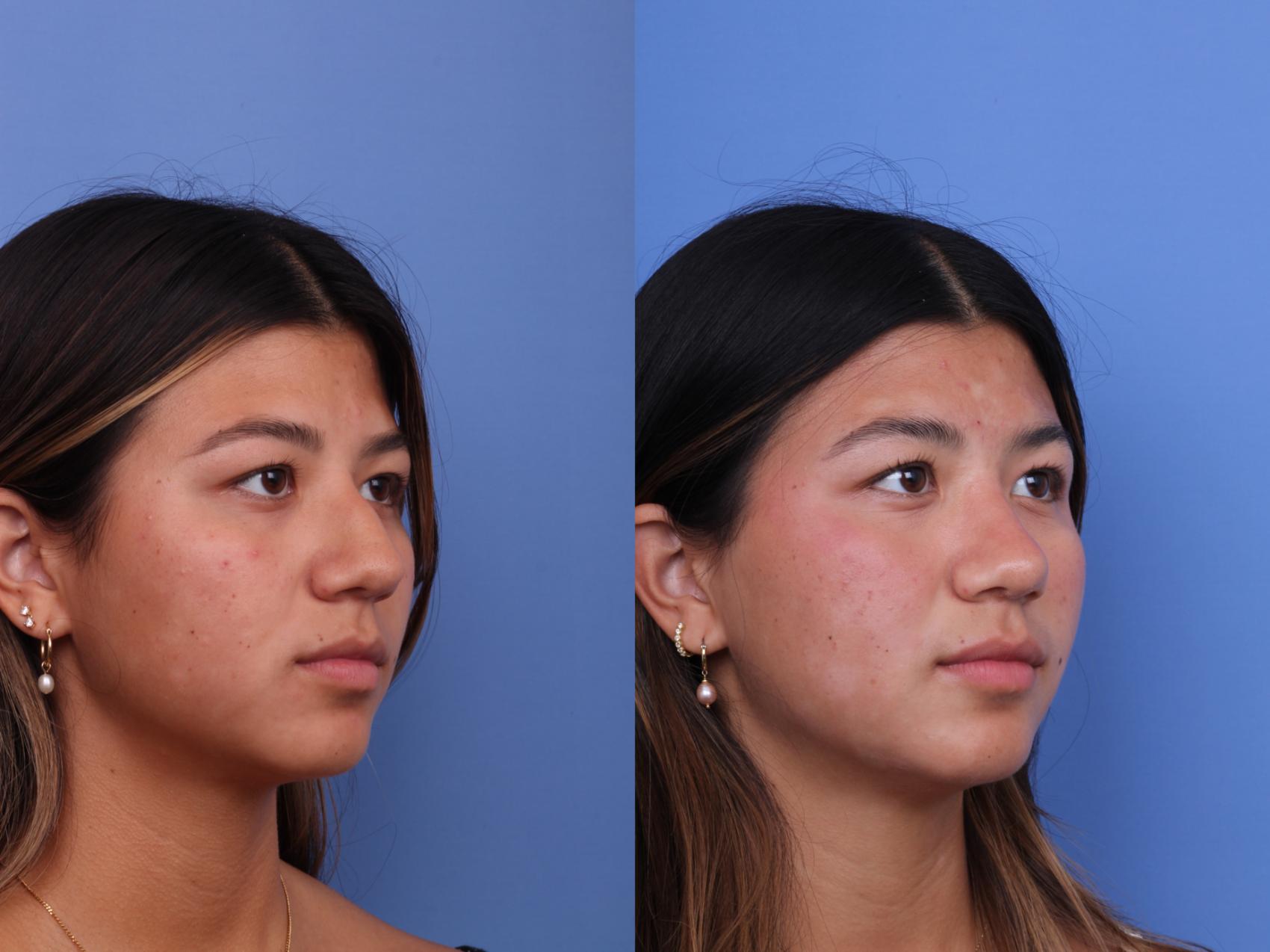 Before & After Rhinoplasty Case 734 Right Oblique View in Scottsdale, AZ