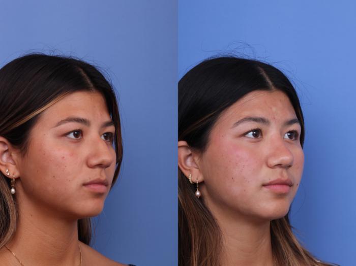 Before & After Rhinoplasty Case 734 Right Oblique View in Scottsdale, AZ