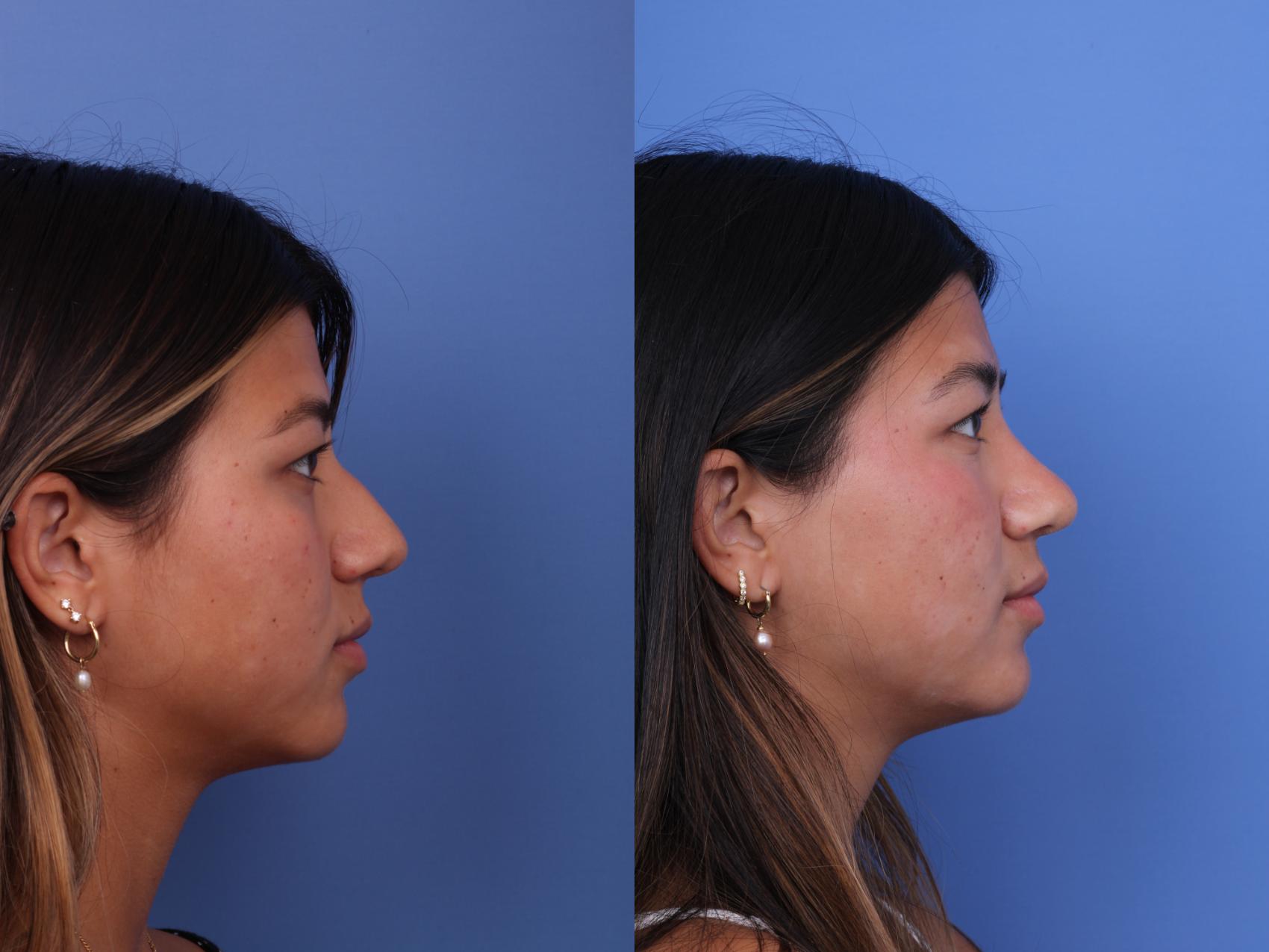 Before & After Rhinoplasty Case 734 Right Side View in Scottsdale, AZ