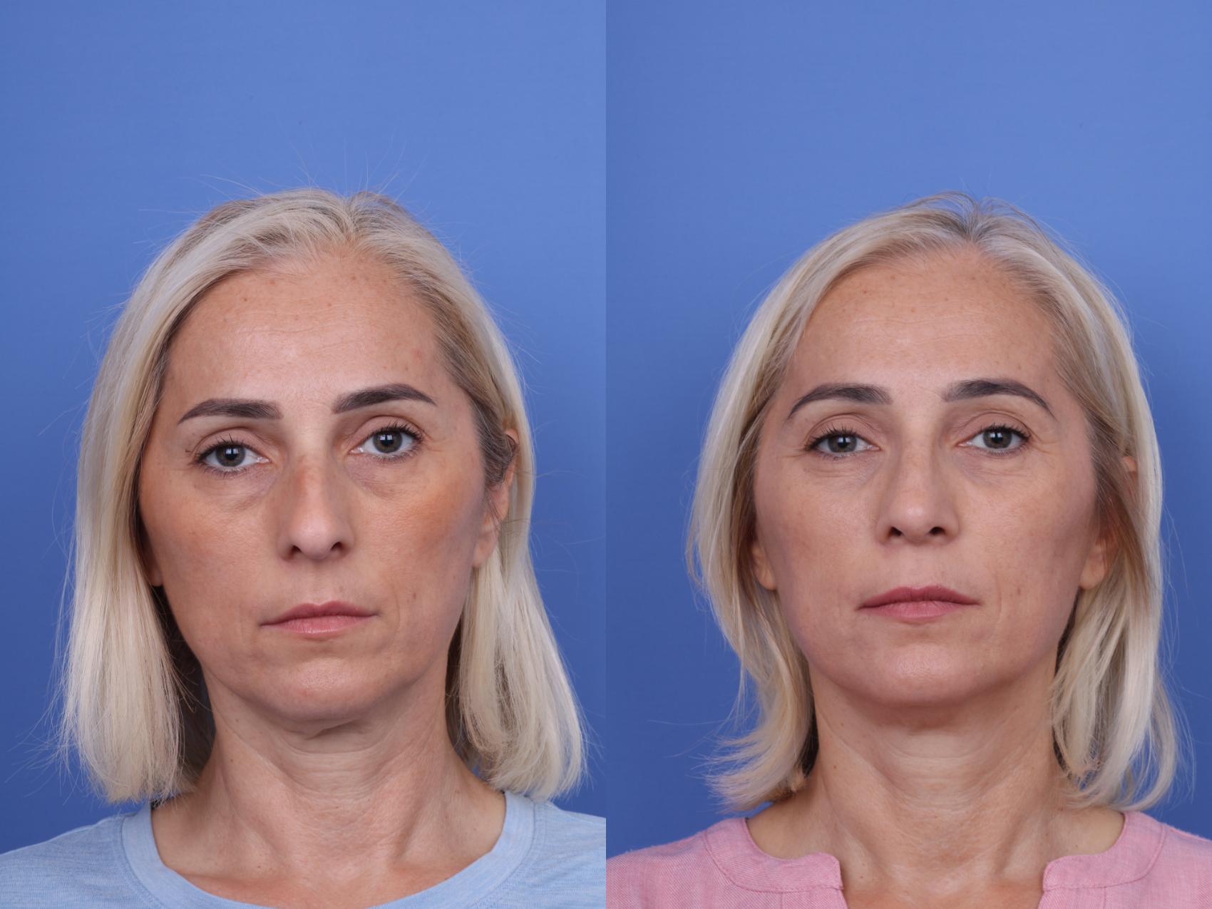 Before & After Rhinoplasty Case 736 Front View in Scottsdale, AZ