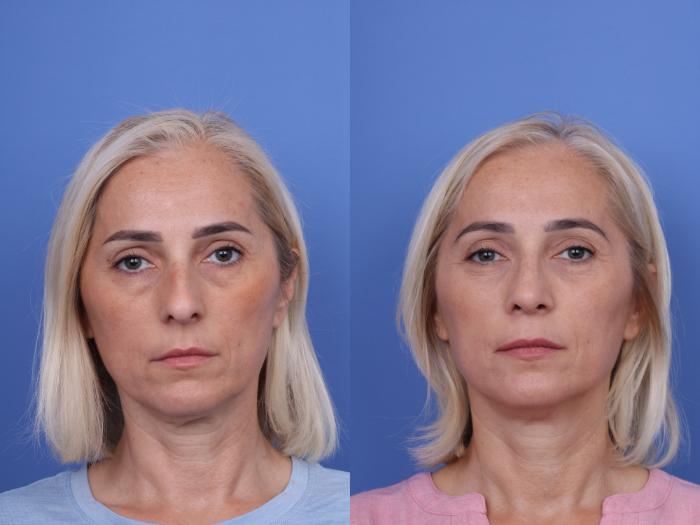 Before & After Rhinoplasty Case 736 Front View in Scottsdale, AZ