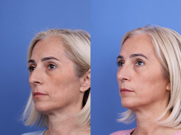 Before & After Rhinoplasty Case 736 Left Oblique View in Scottsdale, AZ