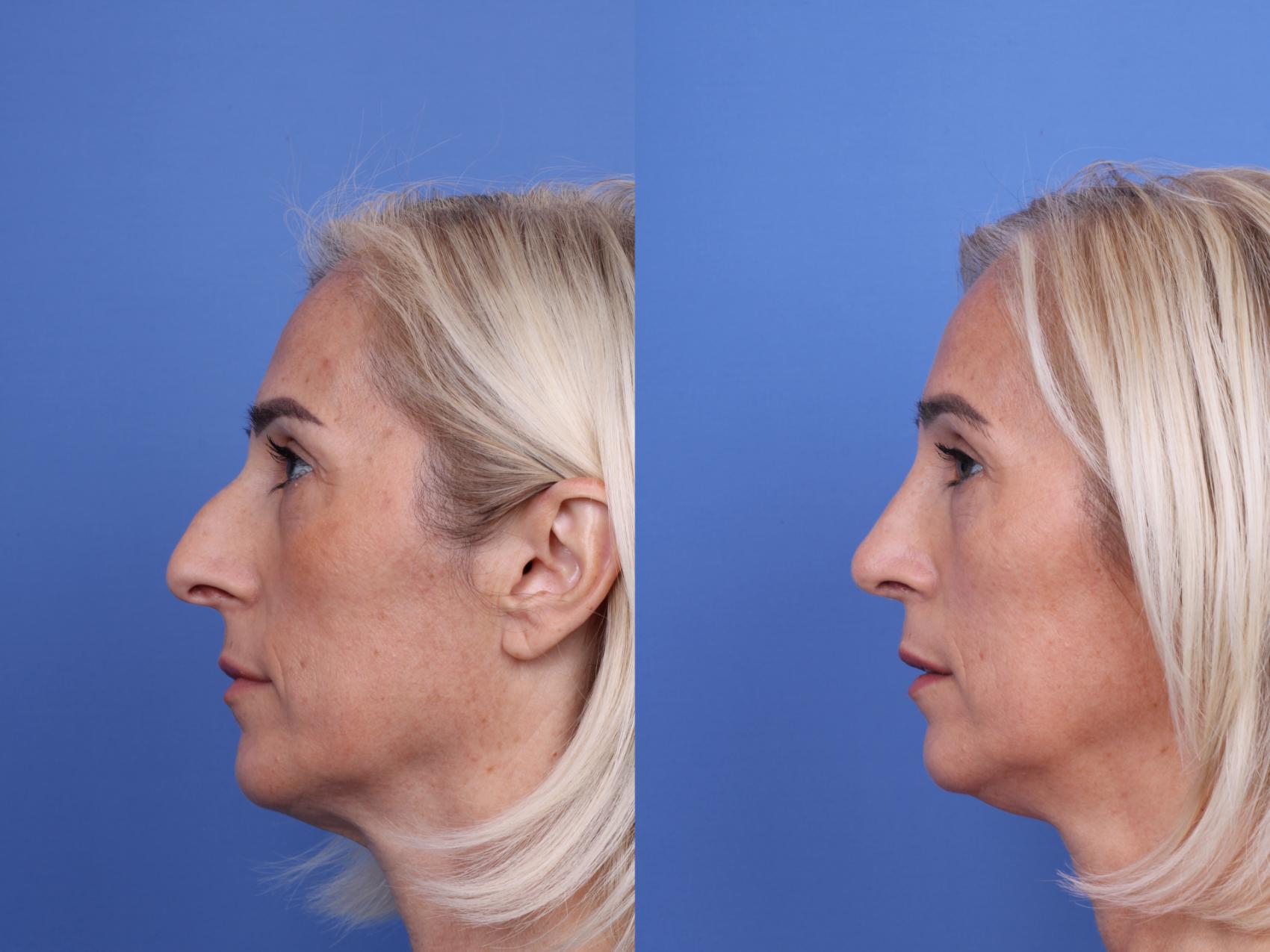 Before & After Rhinoplasty Case 736 Left Side View in Scottsdale, AZ