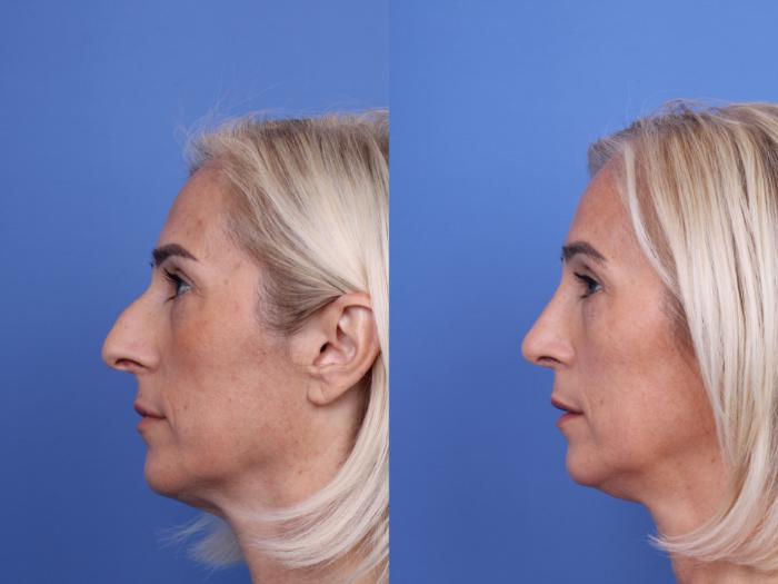 Before & After Rhinoplasty Case 736 Left Side View in Scottsdale, AZ