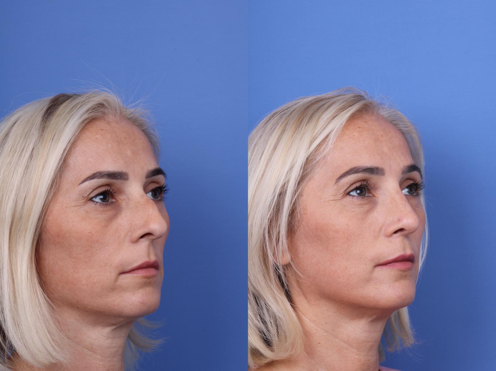 Before & After Rhinoplasty Case 736 Right Oblique View in Scottsdale, AZ