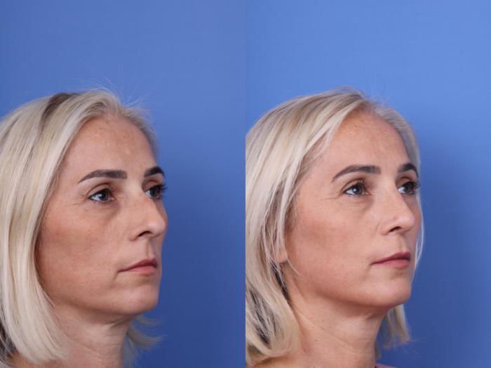 Before & After Rhinoplasty Case 736 Right Oblique View in Scottsdale, AZ
