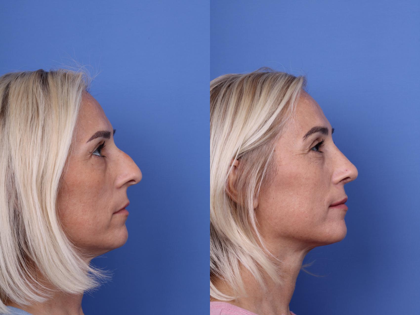 Before & After Rhinoplasty Case 736 Right Side View in Scottsdale, AZ