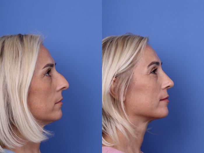 Before & After Rhinoplasty Case 736 Right Side View in Scottsdale, AZ