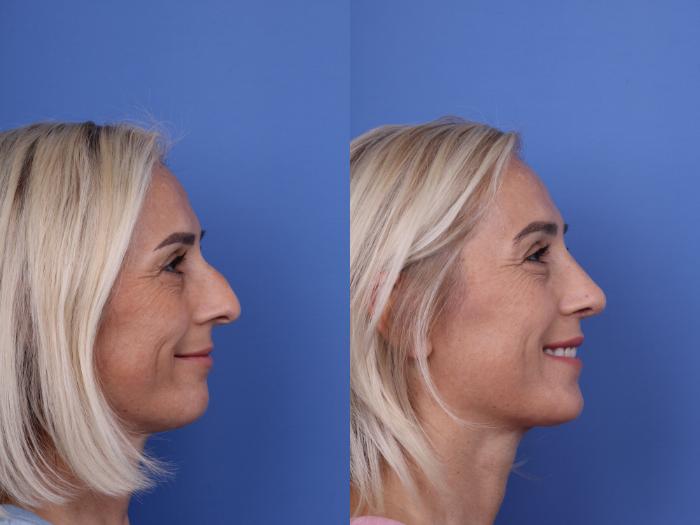 Before & After Rhinoplasty Case 736 Right Smile View in Scottsdale, AZ