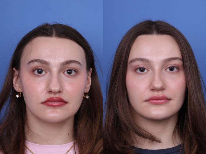 Before & After Rhinoplasty Case 738 Front View in Scottsdale, AZ