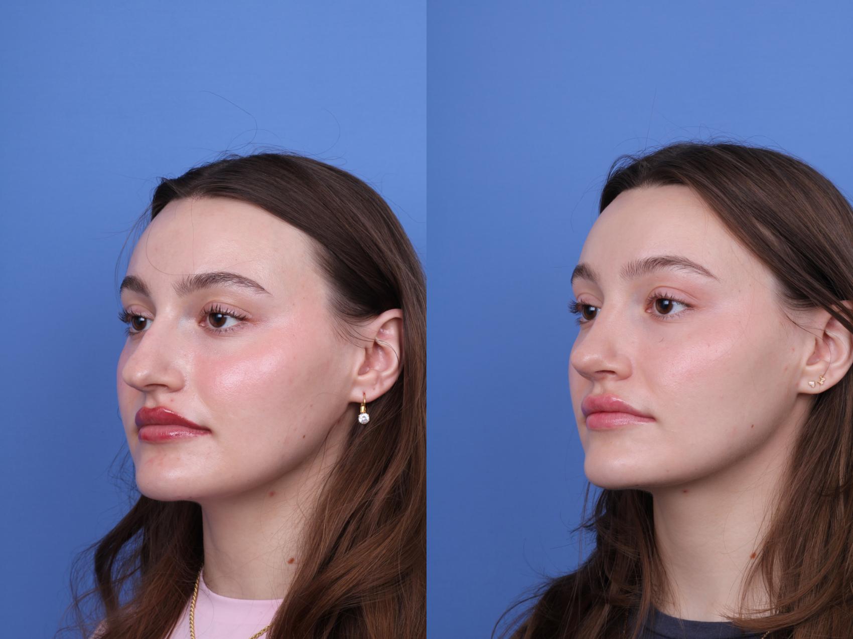 Before & After Rhinoplasty Case 738 Left Oblique View in Scottsdale, AZ