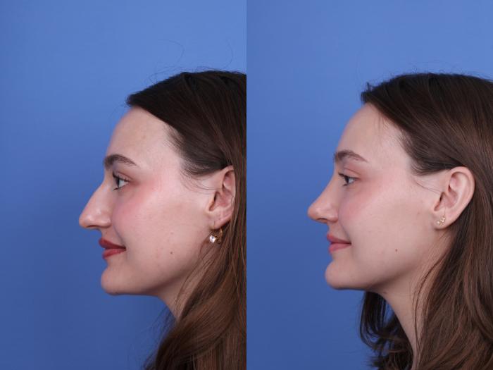 Before & After Rhinoplasty Case 738 Left Smile View in Scottsdale, AZ