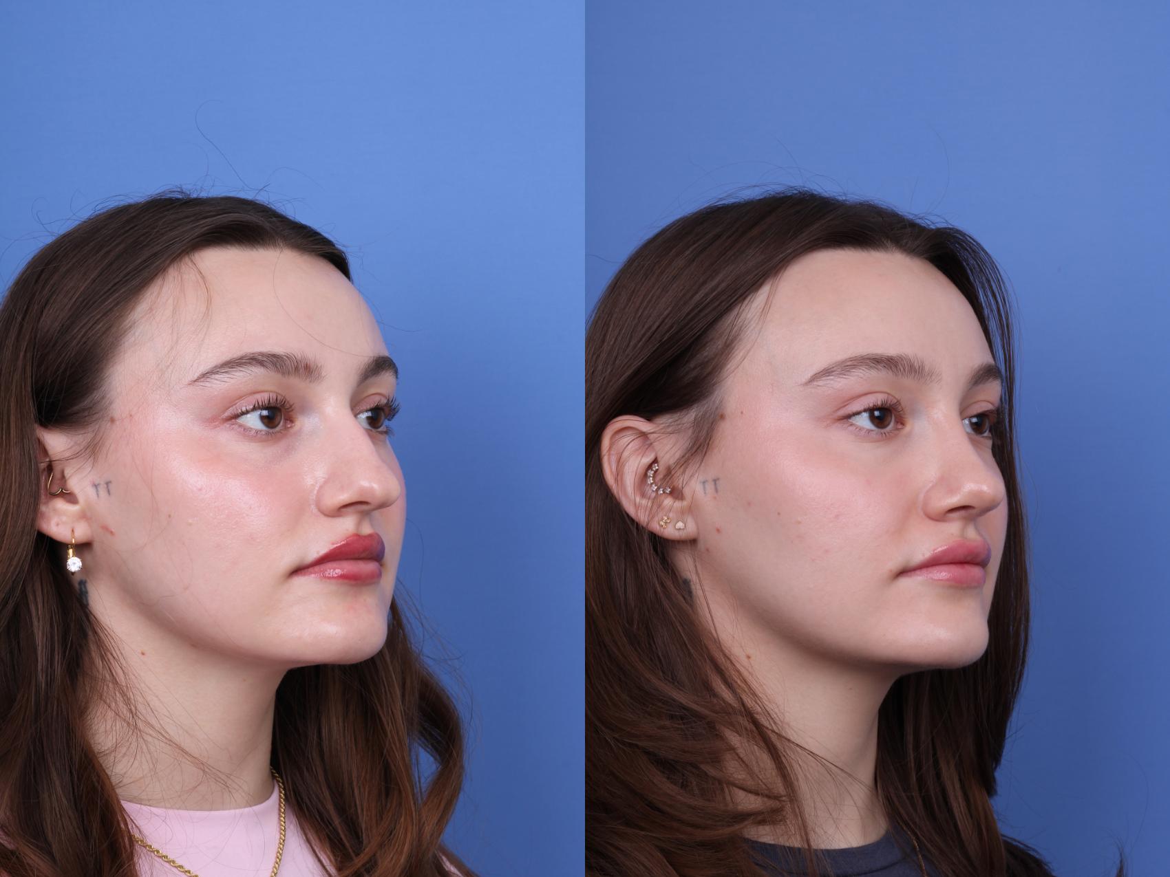 Before & After Rhinoplasty Case 738 Right Oblique View in Scottsdale, AZ