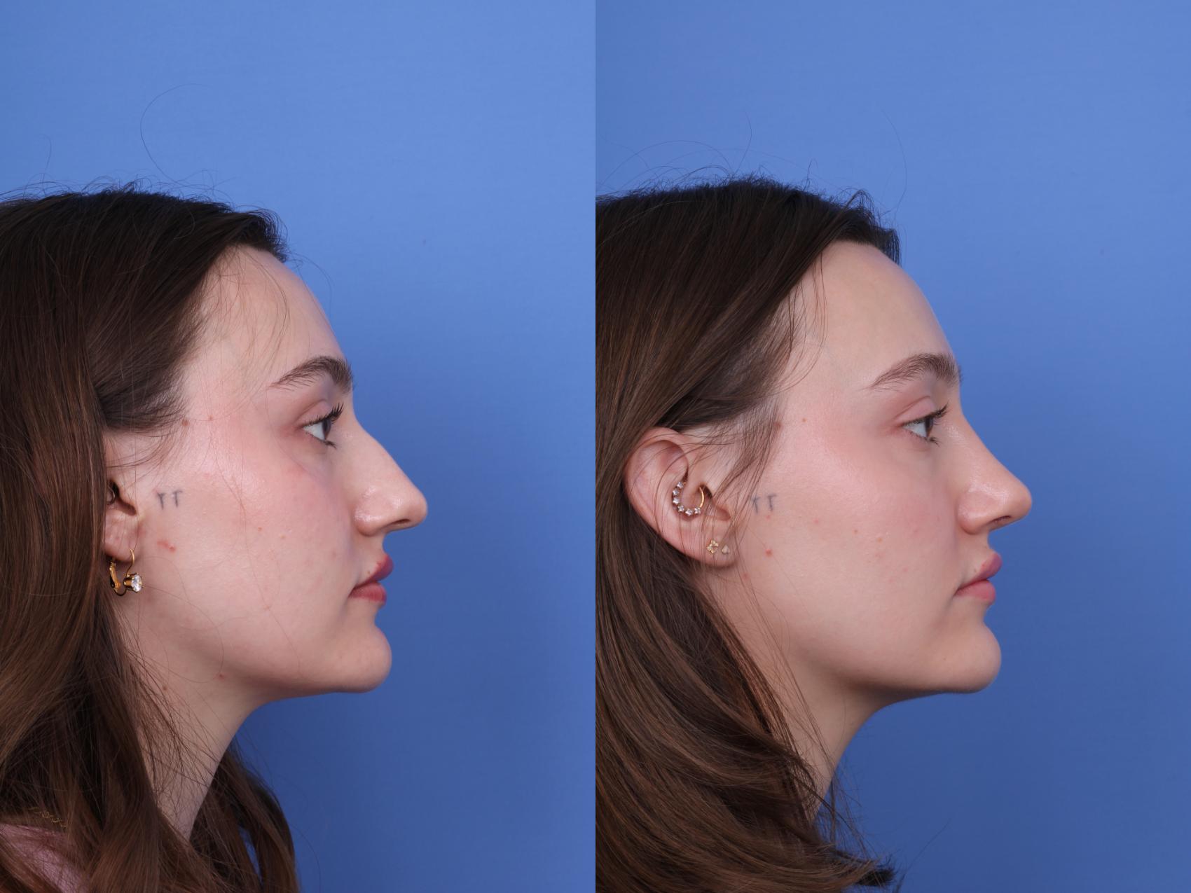 Before & After Rhinoplasty Case 738 Right Side View in Scottsdale, AZ