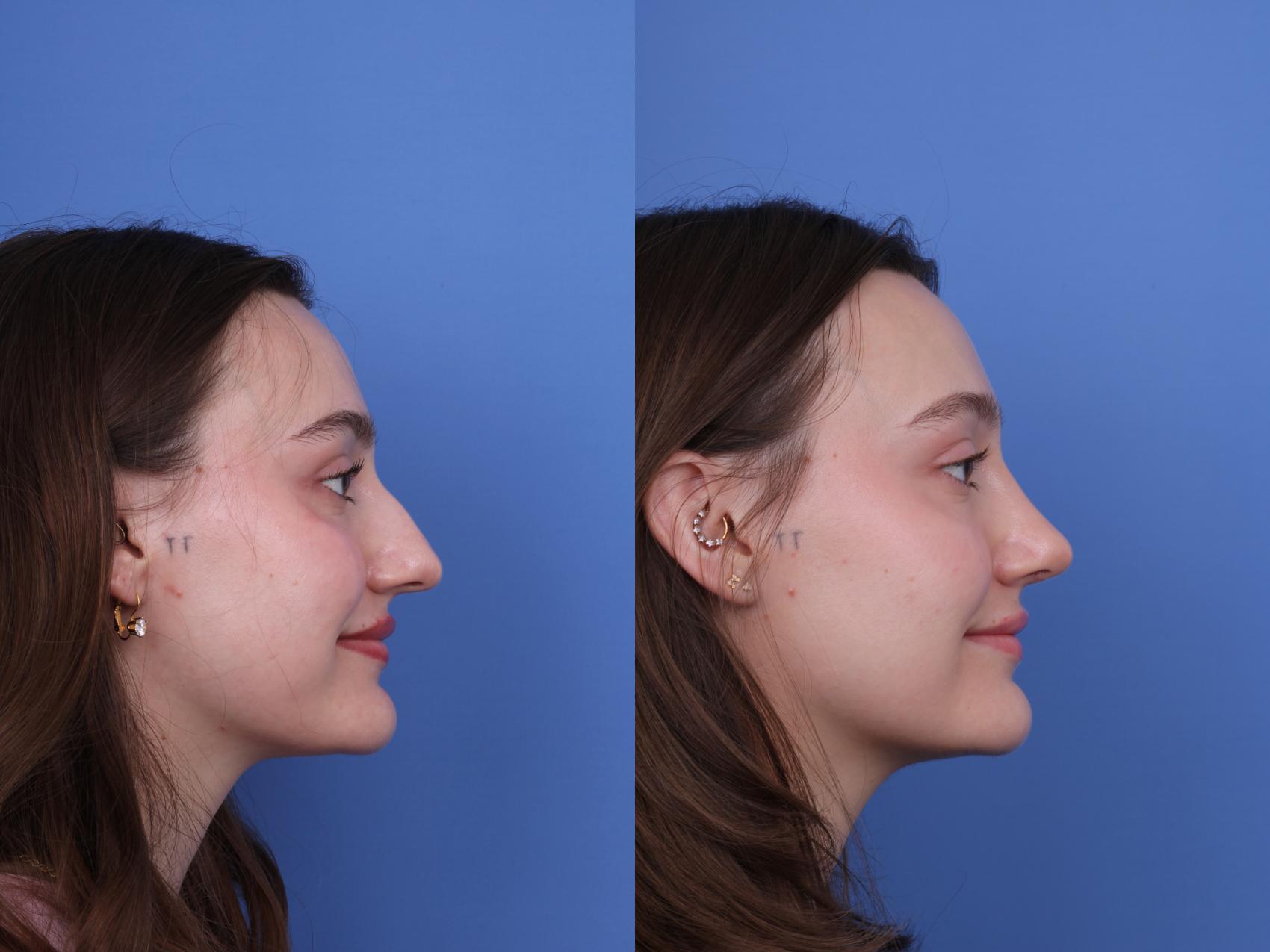 Before & After Rhinoplasty Case 738 Right Smile View in Scottsdale, AZ